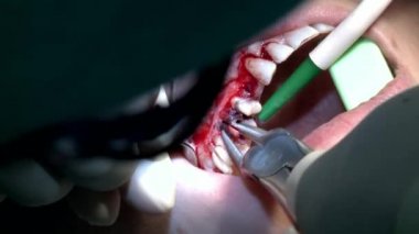 Stomatolog diş kliniğinde dişleri sökmüş.