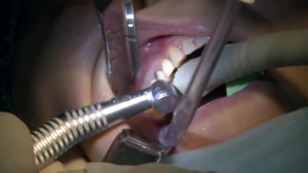 Dentista fare l'estrazione dei denti un paziente in ambulatorio ambulatoriale moderna sala operatoria utilizza moderne attrezzature dentali e anestesia. Primi piani di chirurgia dentale orale e maxillo-facciale. — Video Stock