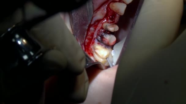 Surgeon do treating teeth a patient in modern office clinic operating room uses modern dental equipment and anesthesia. Close-up dental care oral and maxillofacial implant surgery. — Stock Video