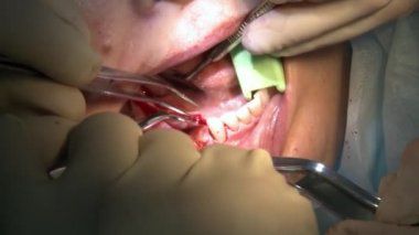 Diş hekimi, modern ofis kliniğindeki bir hastanın dişlerini parlatır. Modern diş aletleri ve anestezi kullanır. Kapalı diş bakımı oral ve maksimum yüz implantı ameliyatı.