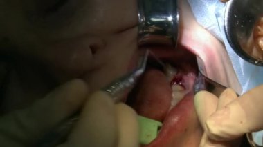 Stomatologlar modern ofis kliniğindeki bir hastanın diş eti ve anestezisini kullanır. Kapalı diş bakımı oral ve maksimum yüz implantı ameliyatı.