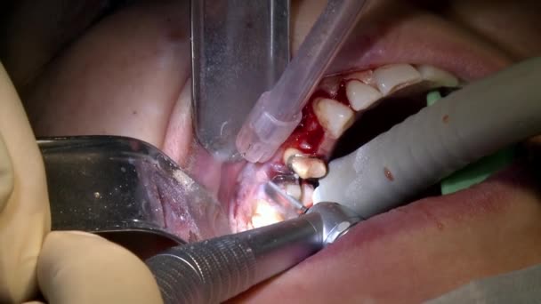 Stomatoloog doen tandverwijdering een patiënt in moderne kantoor kliniek operatiekamer maakt gebruik van moderne tandheelkundige apparatuur en verdoving. Close-up mond- en maxillofaciale implantaatchirurgie. — Stockvideo
