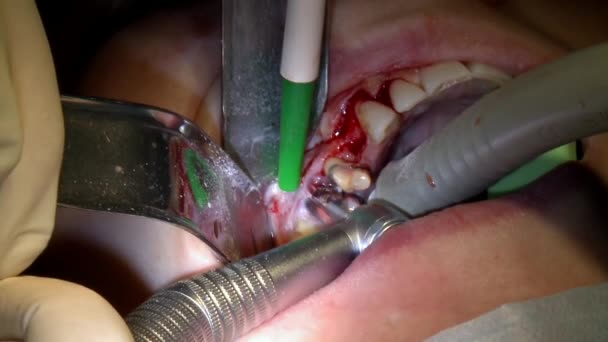 Dentysta używa wiercenia zębów, a pacjent w nowoczesnej sali operacyjnej gabinetu korzysta z nowoczesnego sprzętu stomatologicznego i znieczulenia. Zbliżenie opieki stomatologicznej implanty jamy ustnej i szczękowo-twarzowej. — Wideo stockowe