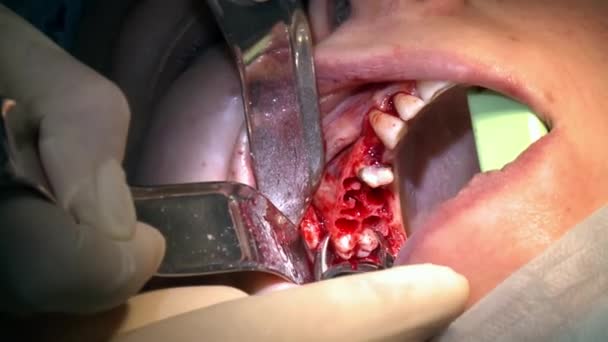 Tandarts maakt gebruik van boortand een patiënt in moderne kantoor kliniek operatiekamer maakt gebruik van moderne tandheelkundige apparatuur en verdoving. Close-up mond- en maxillofaciale implantaatchirurgie. — Stockvideo