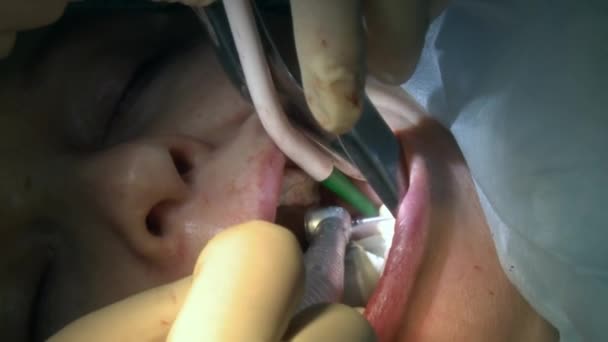 Tandarts doen tandheelkundige extractie een patiënt in moderne kantoor kliniek operatiekamer maakt gebruik van moderne tandheelkundige apparatuur en verdoving. Close-up mond- en maxillofaciale implantaatchirurgie. — Stockvideo
