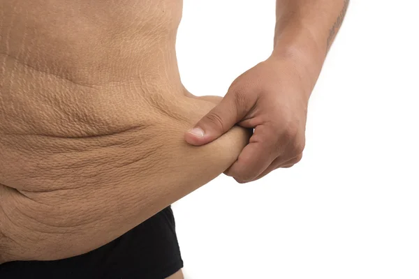 Man with fat belly and stretch marks — Stock Photo, Image