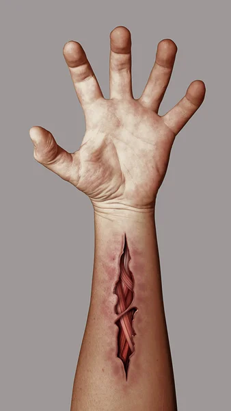 Πληγωμένο του χέρι — Φωτογραφία Αρχείου