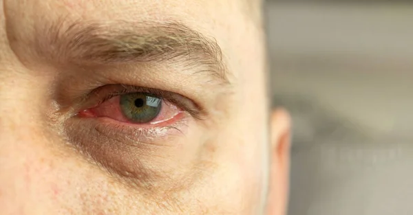 Red and inflamed eye close-up. Patient\'s red eye. Allergic reaction
