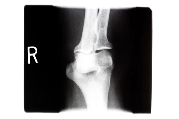 X 射线右膝盖 — 图库照片