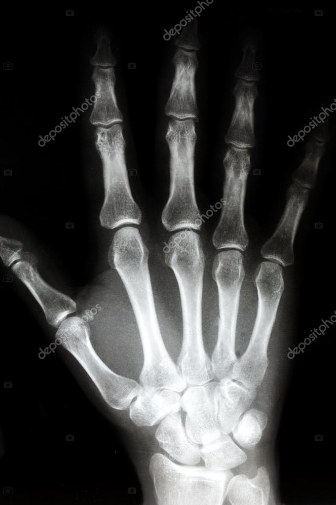 Normal Left Hand X Ray