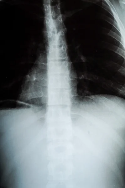 Image radiographique du thorax humain pour un examen médical — Photo