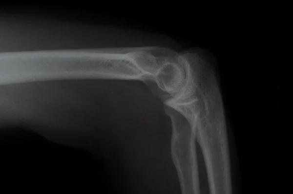 X ray af Elbow — стоковое фото