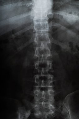 İnsan Göğsünün X-Ray Görüntüsü