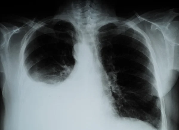 X-ray image of Human Chest — Stock Photo, Image