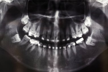 dişlerin panoramik x-ray görüntüsü.