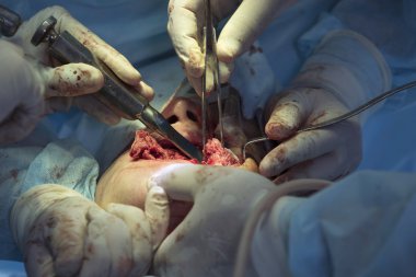 Maxillofacial Surgery Close-Up clipart