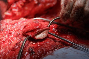 Göbek cerrahi detay