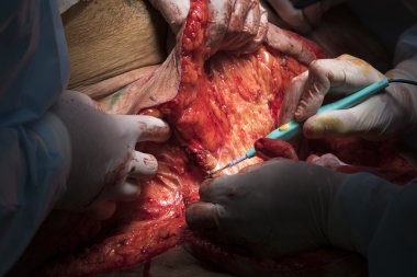 Fazla deri Temizleme