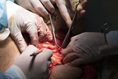 Yağ kaldırma ameliyatı