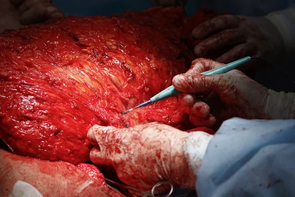 Coagulador en Cirugía — Foto de Stock