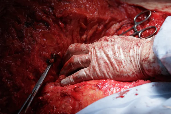 A sebész kezét — Stock Fotó