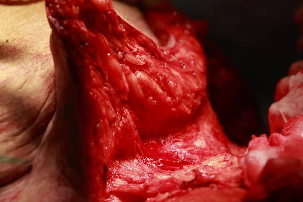 Ameliyat subcutaneous yağlı