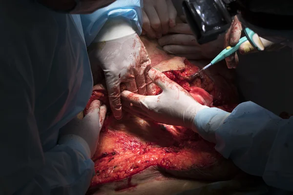 La mano del cirujano en el trabajo — Foto de Stock