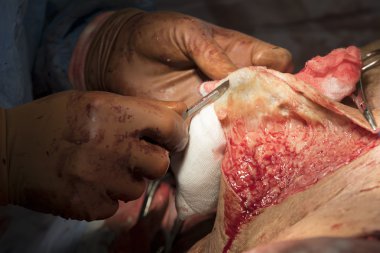 Neşter kullanarak pelt arındırmak