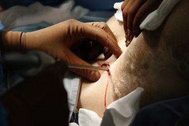 Endo-ameliyat ile cerrahi kesi