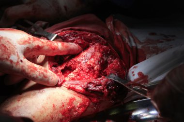 Cerrah'ın parmak yarada