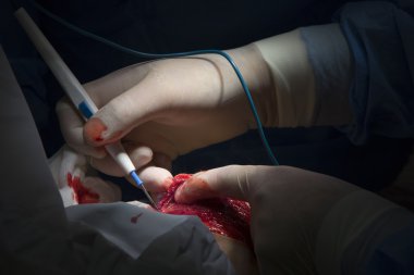 Elektrokoterizasyon yakın çekim