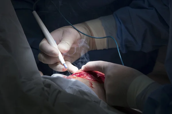 Koagulator ved kirurgisk indgreb - Stock-foto