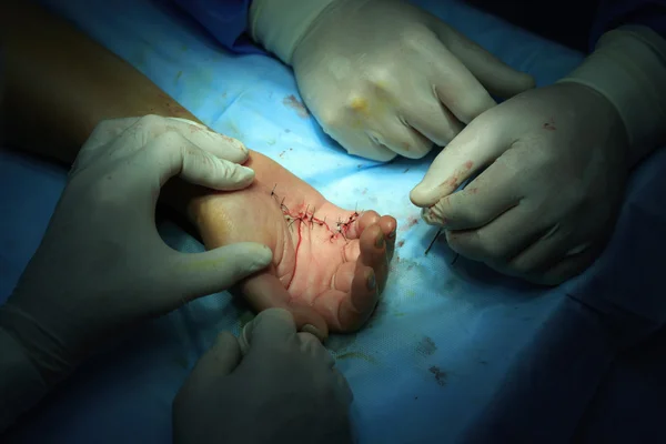 Making stitches on the hand — Stock Photo, Image