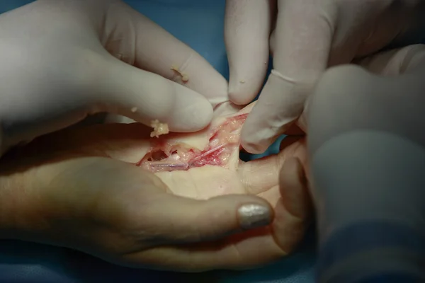 Hand chirurgie close-up — Stockfoto