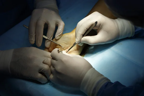 Cirurgia da palma close-up — Fotografia de Stock