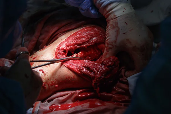 Omuz kemiği ameliyatı — Stok fotoğraf