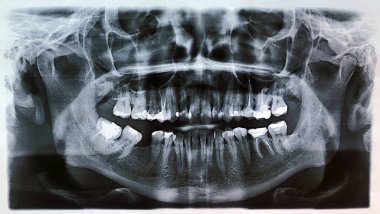 Diş ve çene kişinin panoramik röntgenini kapat