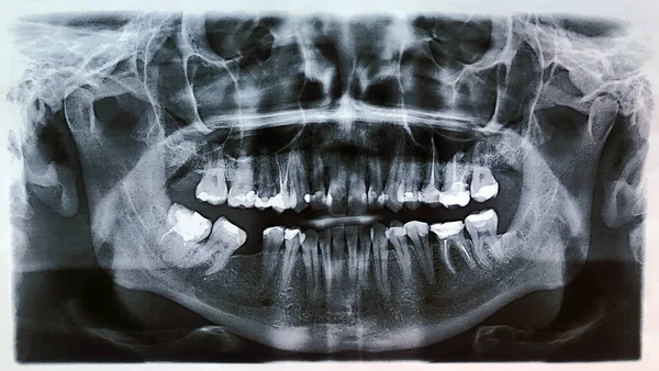 Close up panoramic x-ray of teeth and jaw person