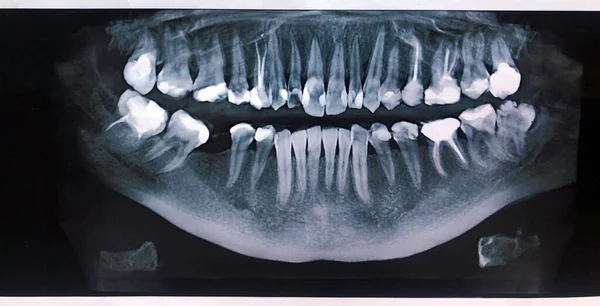 Close up panoramic x-ray of teeth and jaw person