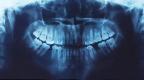 X 光的牙齿，口腔医学概念 — 图库照片