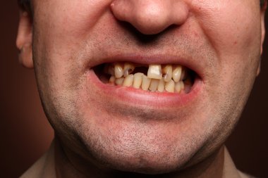 Kötü diş sigara içen