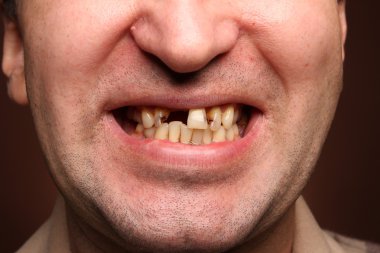 Kötü diş sigara içen