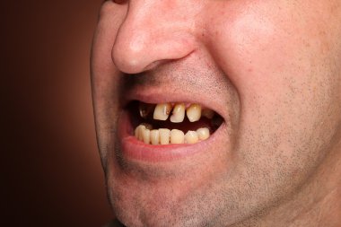 Kötü diş sigara içen