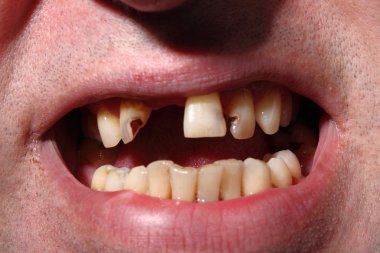 Kötü diş sigara içen