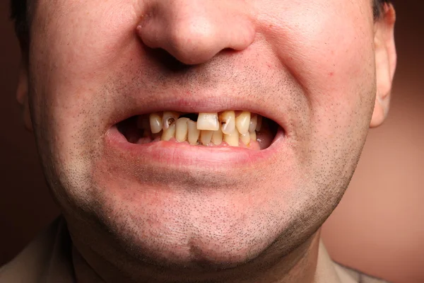Raucher mit schlechten Zähnen — Stockfoto