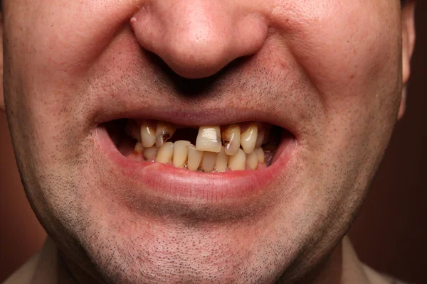 Bad teeth smoker — Stock Photo, Image