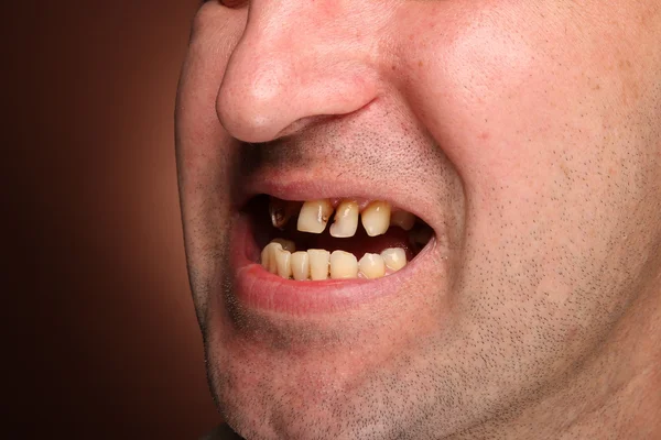 Kötü diş sigara içen