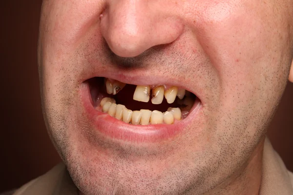 Kötü diş sigara içen