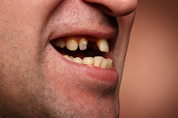 Fumator de dinti rau — Fotografie, imagine de stoc