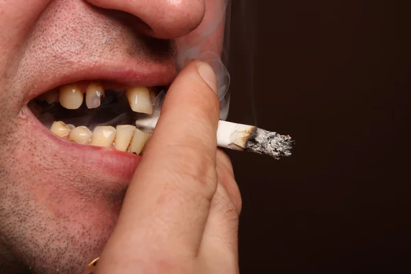 Denti cattivi fumatore — Foto Stock